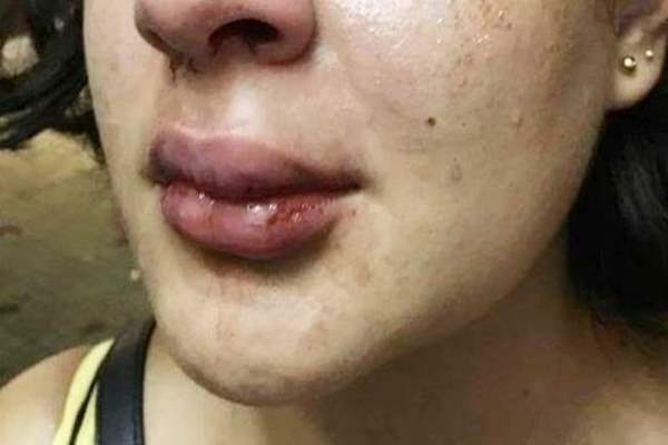 Mulher é violentamente agredida pelo marido no bairro Aponiã