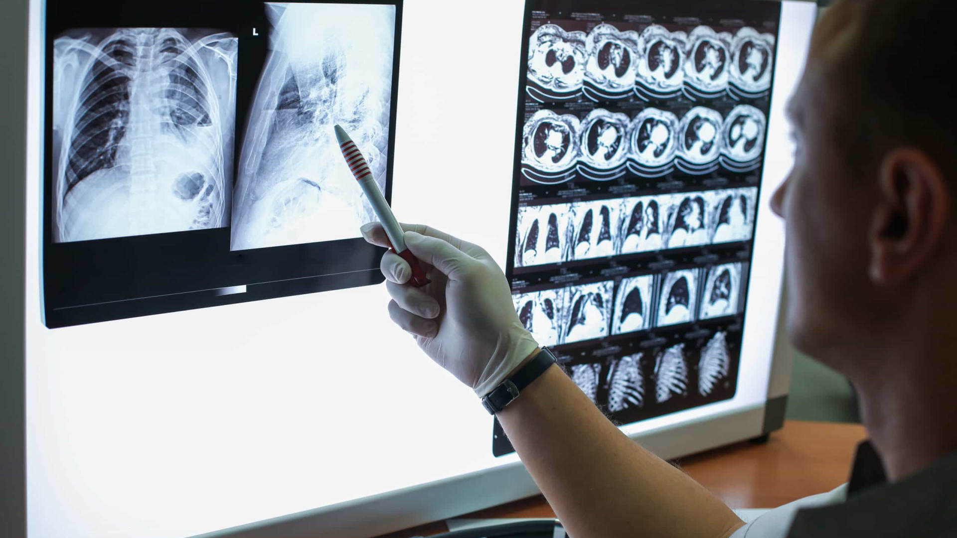 Brasil terá 704 mil novos casos de câncer por ano até 2025 , prevê Inca
