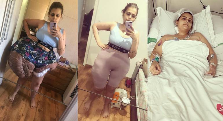 Médicos brasileiros retiram quase 35 kg de tumor de mulher com doença rara: 'Salvou a vida dela'
