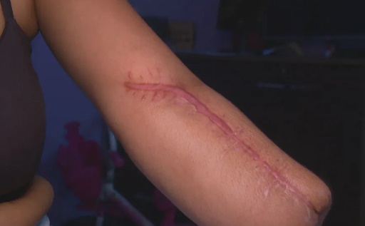 Mulher vai a hospital no Rio de Janeiro para dar à luz e sai com mão amputada
