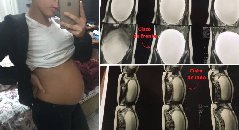 Jovem que removeu cisto de 7 kg do ovário lembra: 'Quase perdi minha vida'
