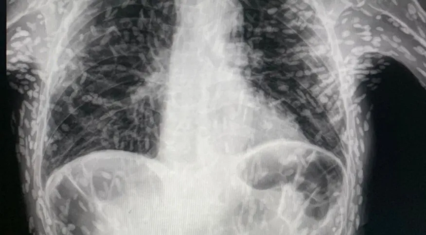 Radiografia de tórax viraliza na internet; entenda os riscos da cisticercose
