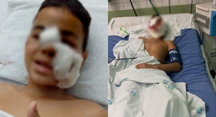 Criança de 10 anos tem orelha decepada ao ser atacada por pitbull no interior de SP
