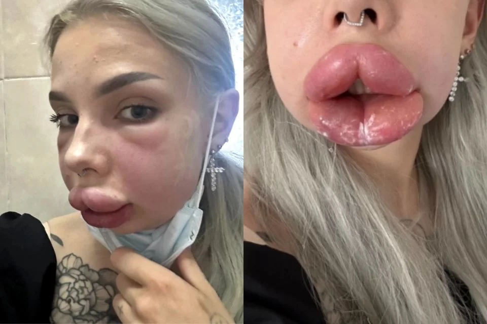 Jovem fica deformada após reação a procedimento labial desastroso: “Quase morri”
