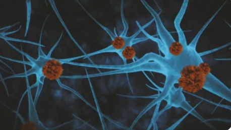 Droga retarda a progressão do Alzheimer em 60% para pacientes em estágios iniciais da doença
