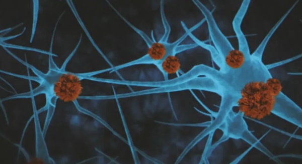 Droga retarda a progressão do Alzheimer em 60% para pacientes em estágios iniciais da doença
