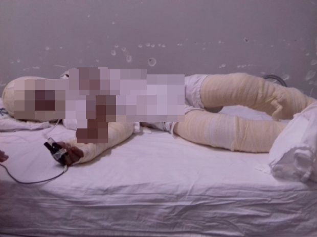 Criança de três anos tem mais de 60% do corpo queimado e é levada em estado grave para UTI 