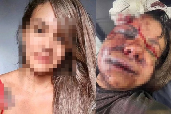 Mulher espancada com 60 socos por ex-namorado passará por cirurgia de reconstrução facial 
