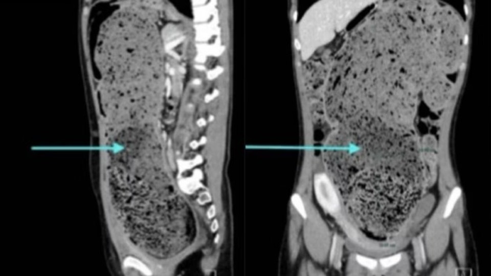 Mulher passa quatro meses constipada e perde 4,5 kg após tratamento
