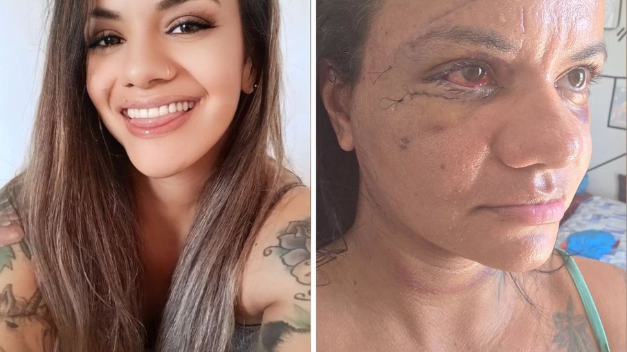 Mulher espancada com 61 socos mostra o rosto após cirurgias de reconstrução facial 
