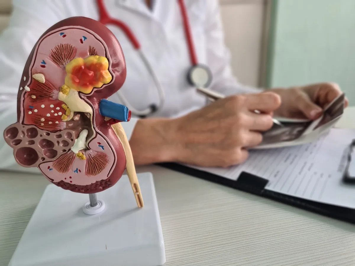 Câncer renal deve crescer quase 80% no Brasil e na América Latina até 2050
