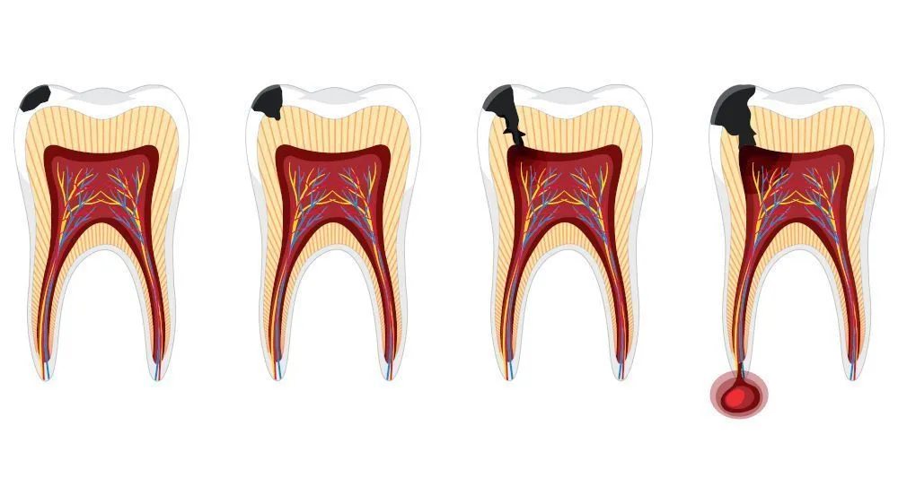 Exercício físico e ômega-3 ajudam a reduz gravidade de infecção dental
