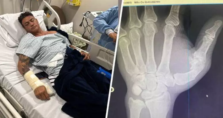Popó passa por cirurgia na mão após briga generalizada com Wanderlei Silva
