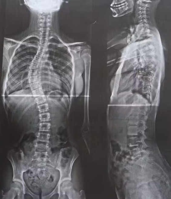 Mãe luta na Justiça para garantir cirurgia de filha com escoliose grave em Rondônia

