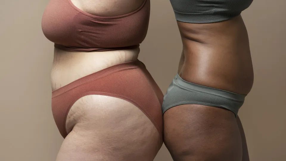 Lipedema é uma doença pouco conhecida e com impacto significativo

