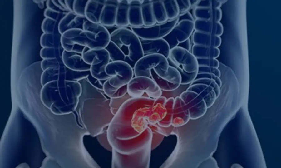 Diagnóstico tardio marca casos de câncer colorretal no Brasil