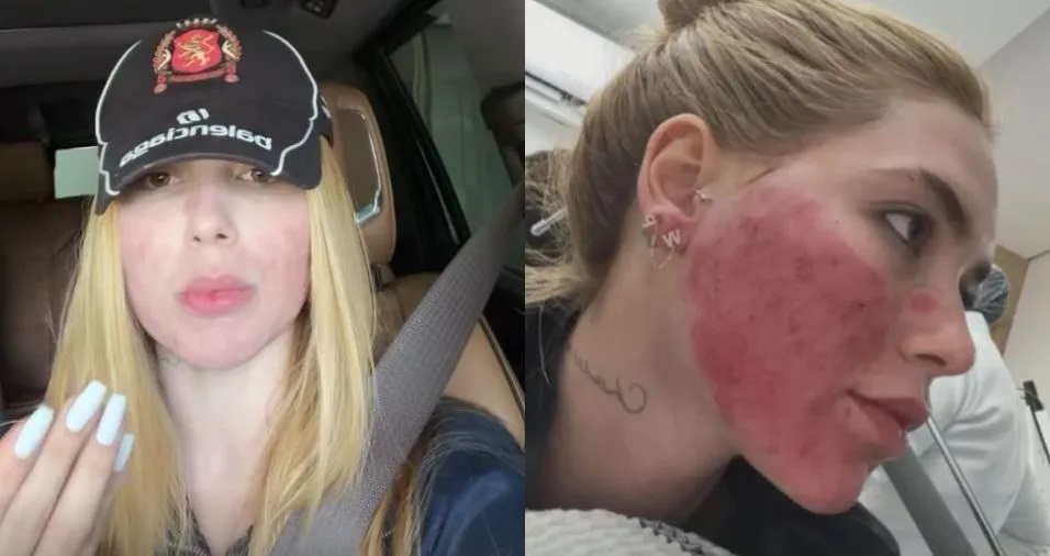 Virginia Fonseca se arrepende de procedimento no rosto: "Tinha necessidade?"
