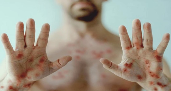 Rondônia confirma mais dois casos de Mpox e chega a seis registros da doença