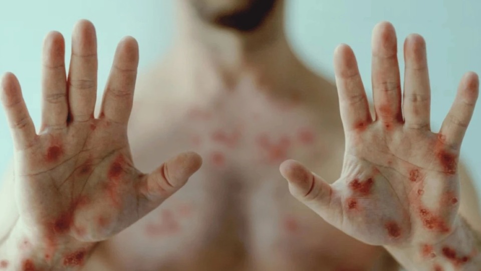 Casos de mpox chegam a 16 em Rondônia; pacientes têm entre 8 e 38 anos