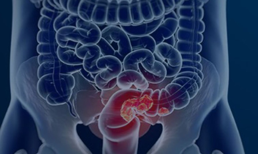 Rastreamento para câncer colorretal pode ser implementado no SUS