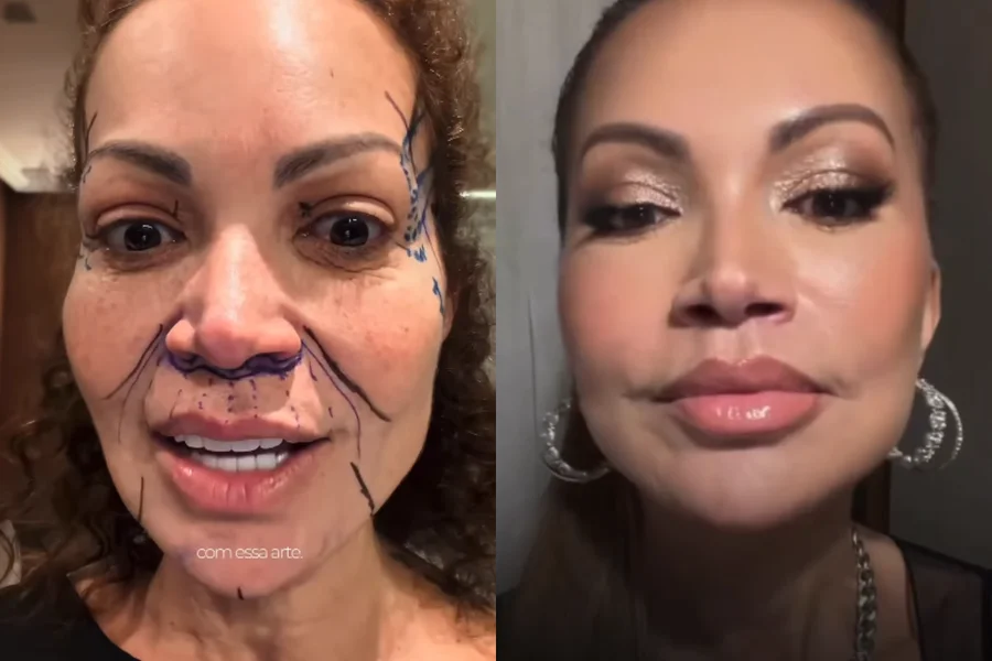 Solange Almeida mostra transformação no rosto após lifting facial: "Transformação"
