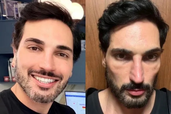 Influenciador choca com antes e depois após 60 dias de caneta emagrecedora: "Mounjaro"