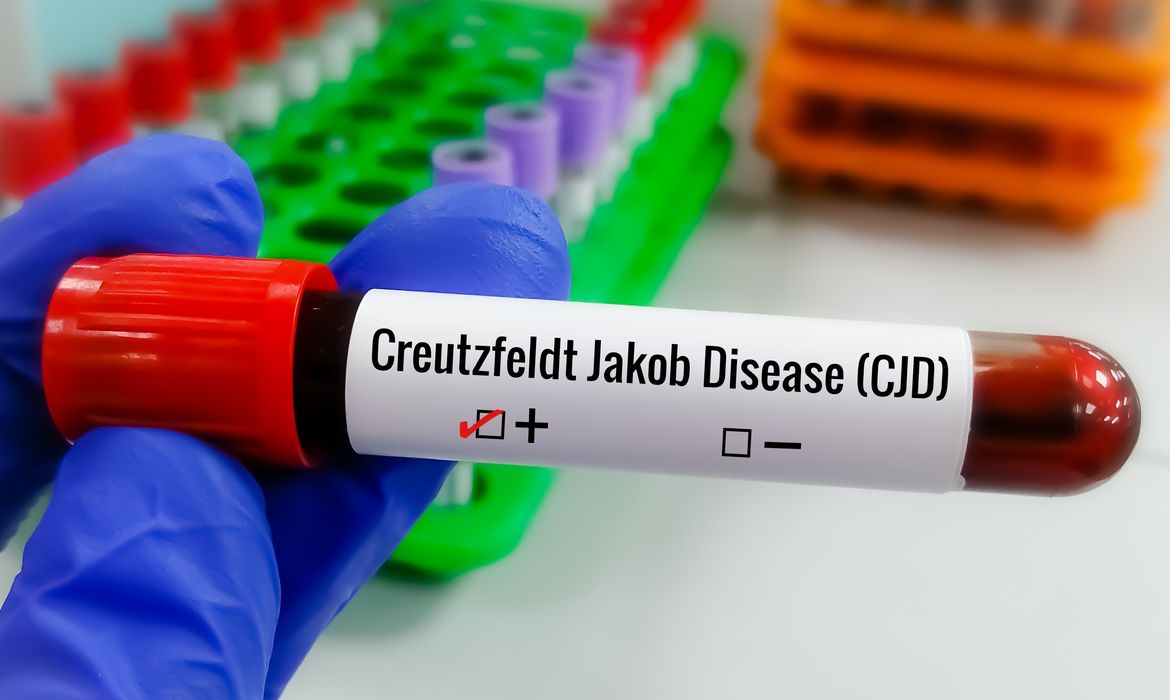 Entenda Doença de Creutzfeldt-Jakob e busca por tratamento
