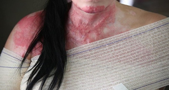 Após briga por ciúmes homem coloca fogo em mulher 