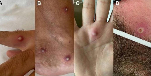 

Na Itália, homem é diagnosticado com HIV, Covid e varíola do macaco