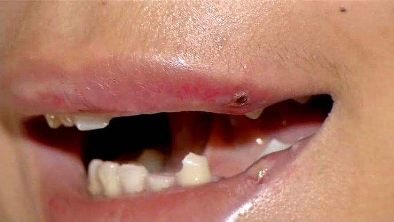 Mulher tem o dente quebrado após pedir para irmão parar de beber