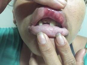 Durante festa de natal homem espanca e quebra dente da esposa