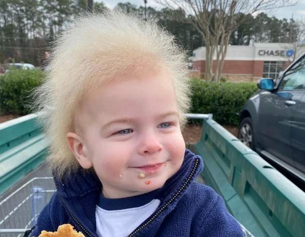 Menino com ‘síndrome do cabelo impenteável’ faz sucesso nas redes sociais; veja fotos
