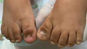 Menina de 2 anos é levada ao hospital sem duas unhas e com lesões no intestino