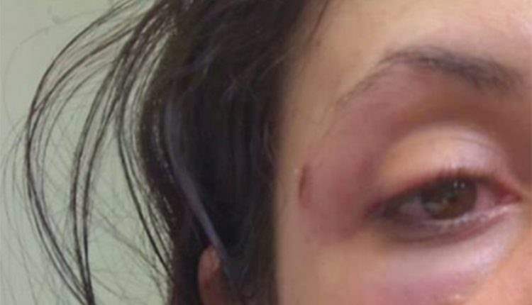 Marido bêbado surra esposa e deixa com maxilar quebrado