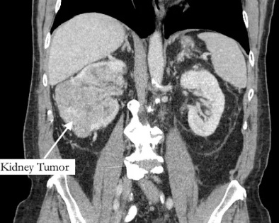 Homem vai tratar dor no dedão do pé e descobre tumor em fase terminal
