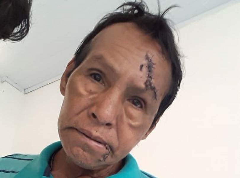 Indígena que sobreviveu a luta com onça teve premonição antes do ataque