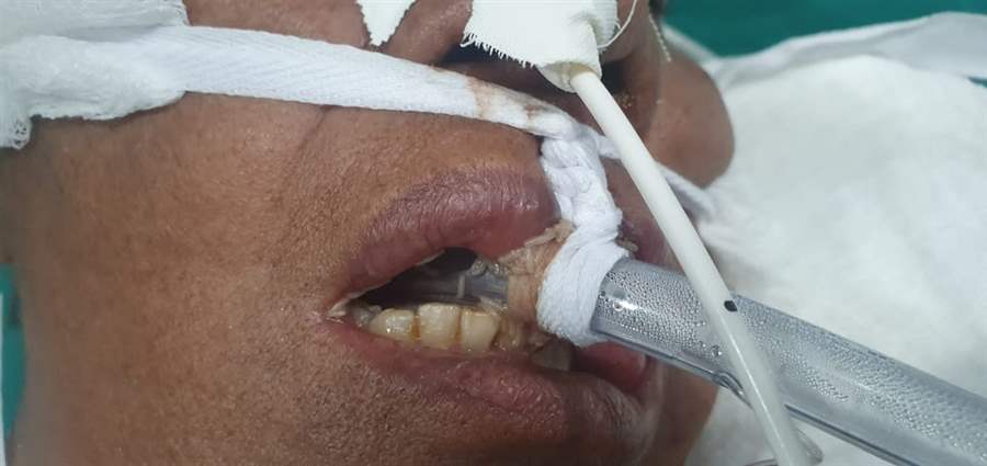 COREN diz que pacientes do Hospital de Campanha tem larvas na boca