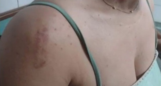 Mulher é atacada por amigo de infância e reage a estupro em Porto Velho