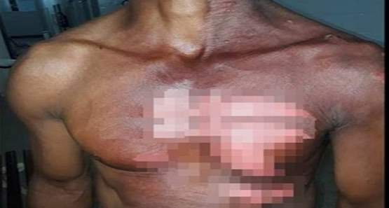 Marido chega bêbado em casa e esposa joga óleo fervendo, na zona leste