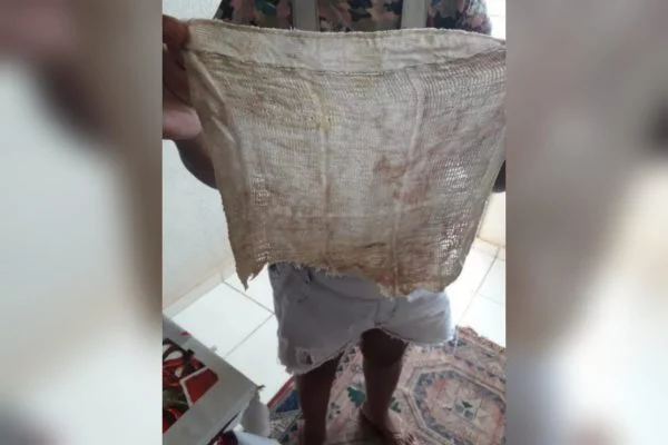 Mulher DE 35 anos passa mal e descobre pano dentro de ânus 6 meses após cesárea