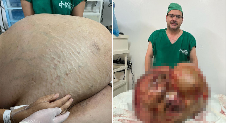 
Mulher pensou que estava engordando, mas tinha um tumor de 46 kg